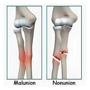 Malunion and Non-Union Fracture