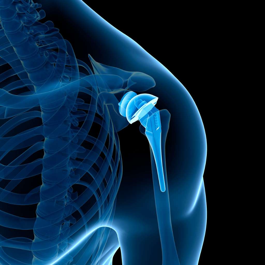 Computer-assisted Shoulder Replacement Surgery