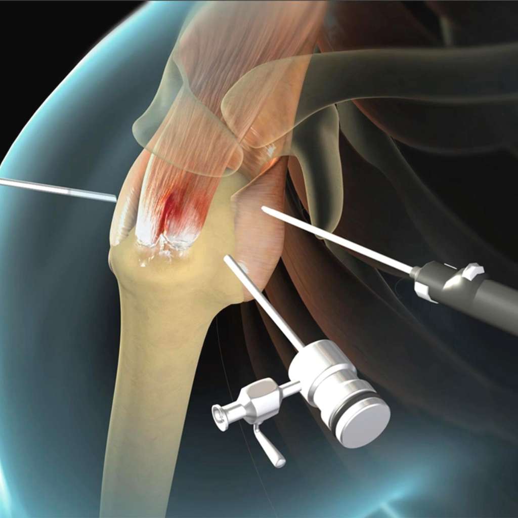 Arthroscopic Rotator Cuff Repair