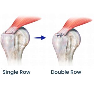 Double row Rotator Cuff Repair Procedure