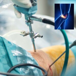 Arthroscopic Meniscus Surgery