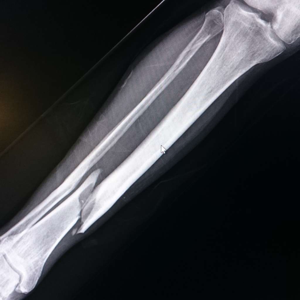 leg bone broken x-ray image