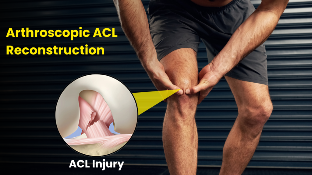 Arthroscopic ACL Reconstruction