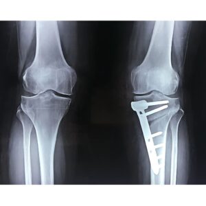 High Tibial Osteotomy