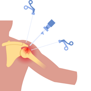 Arthroscopic Rotator Cuff Repair in Athletes