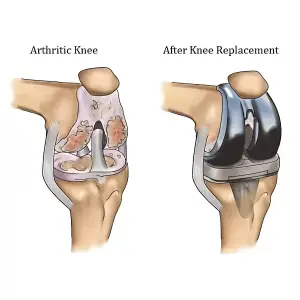 Cost of Knee replacement in Mumbai